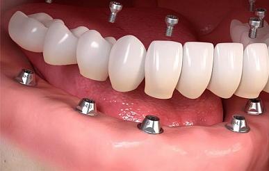 Импланты при полном отсутствии зубов