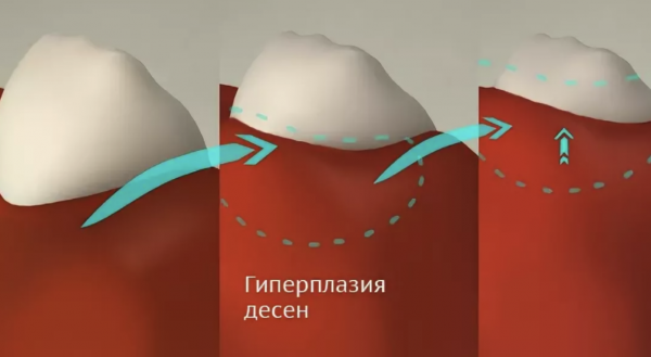 Гиперплазия десен — что это такое?