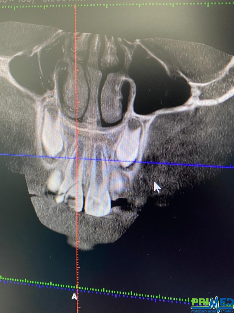 После лечения
