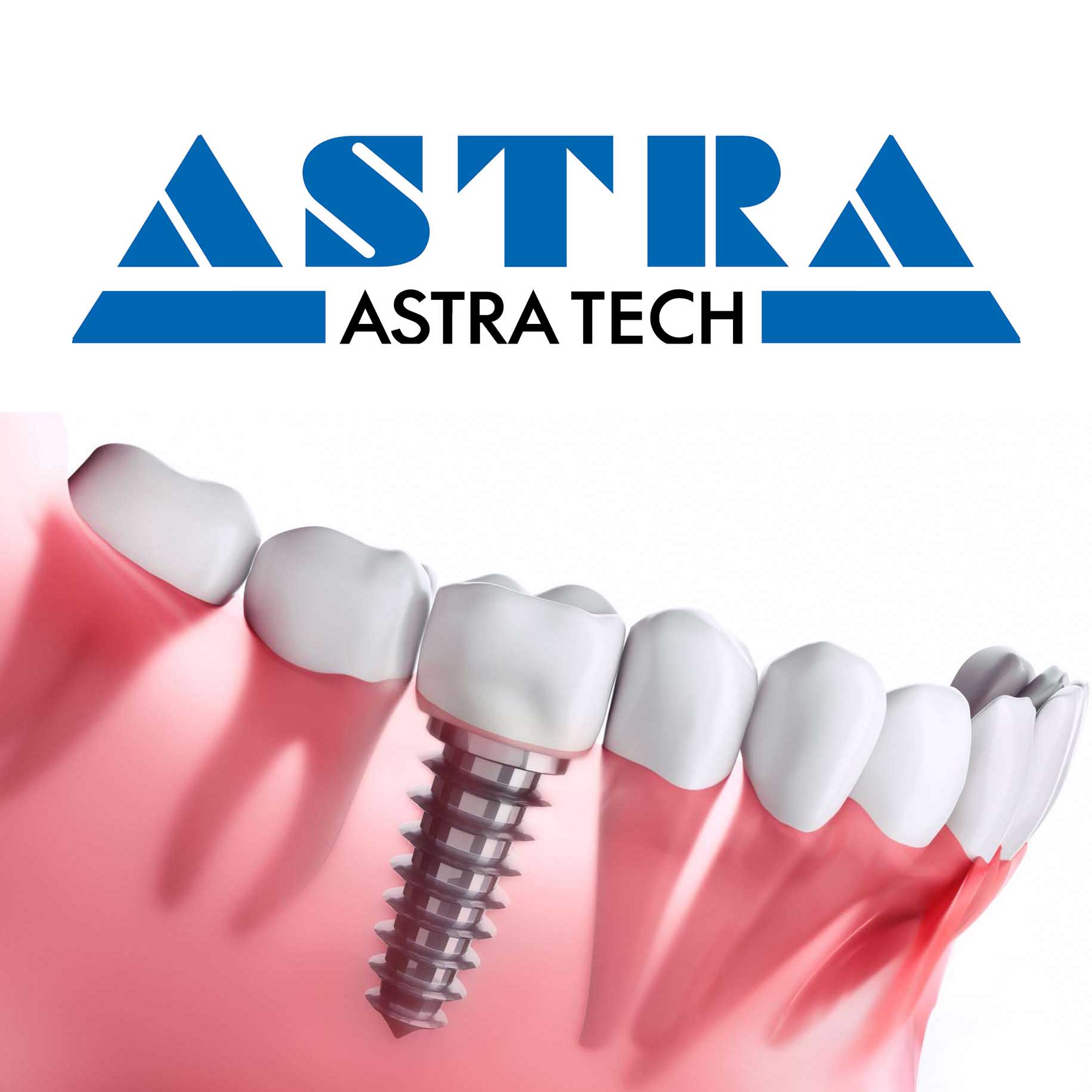 Установка имплантов AstraTech под ключ
