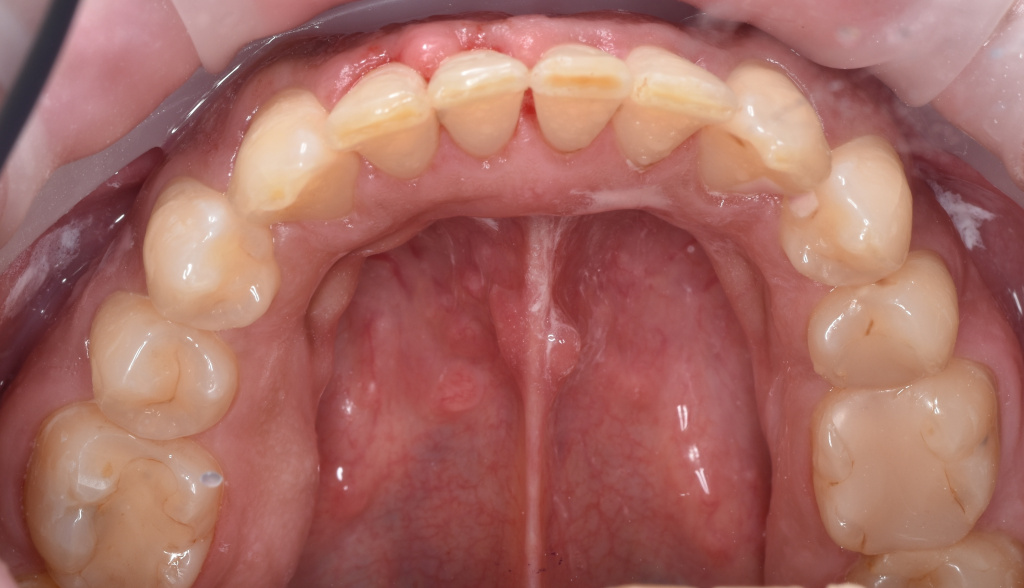 Фото 6 (после- вид изнутри, нижние зубы).JPG