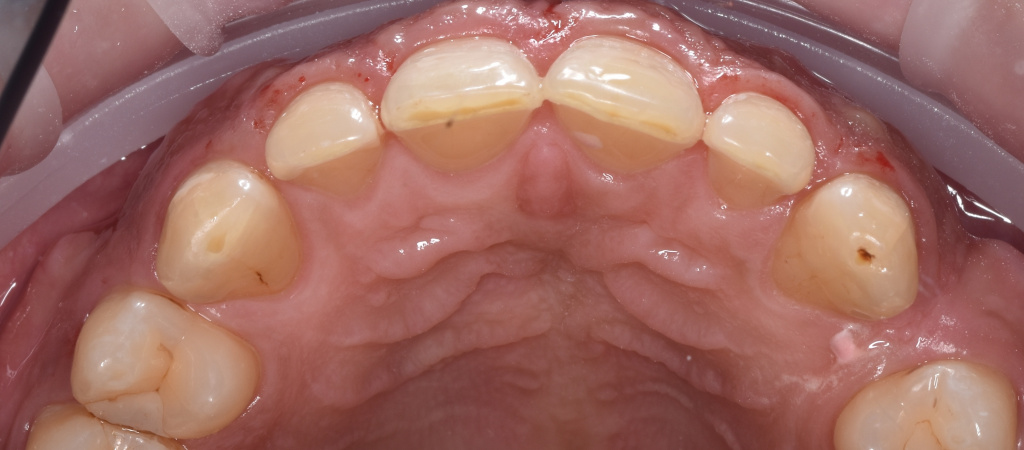 Фото 5 (после- вид изнутри, верхние зубы).JPG