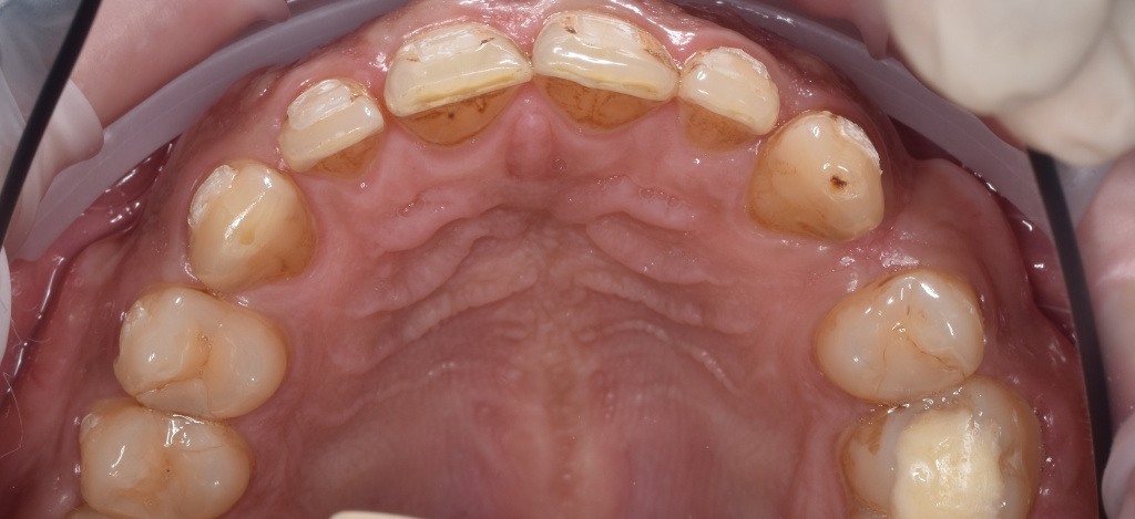 Фото 2 (до- вид изнутри, верхние зубы).JPG