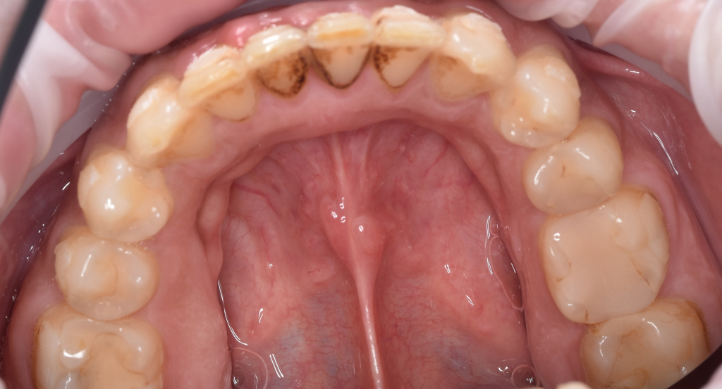 Фото 3 (до- вид изнутри, нижние зубы).JPG