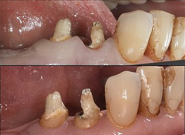 Удлинение клинической шейки зуба