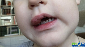 Осложнение после лечения зубов у детей: накусывание мягких тканей