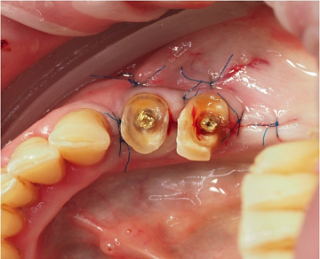 Разрушение коронковой части зуба